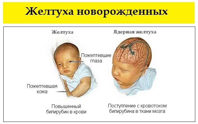 Энцефалопатия новорожденных