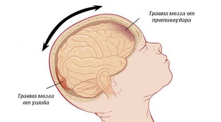 Симптомы и признаки сотрясения головного мозга у грудничка, возможные последствия