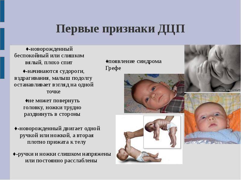 Симптомы и признаки ДЦП у новорожденных, как проявляется и распознается заболевание
