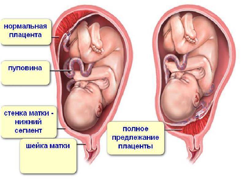 Плацентарные нарушения | что делать, если нарушилось плацентарное состояние? | лечение нарушений и симптомы болезни на eurolab