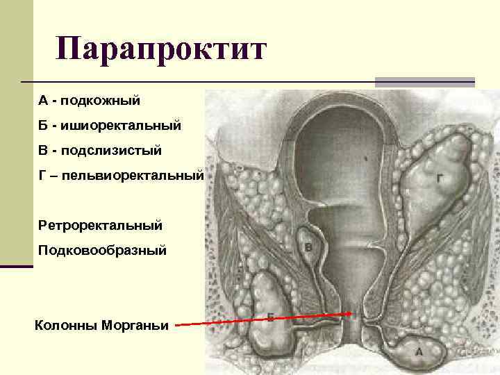 Хронический парапроктит презентация