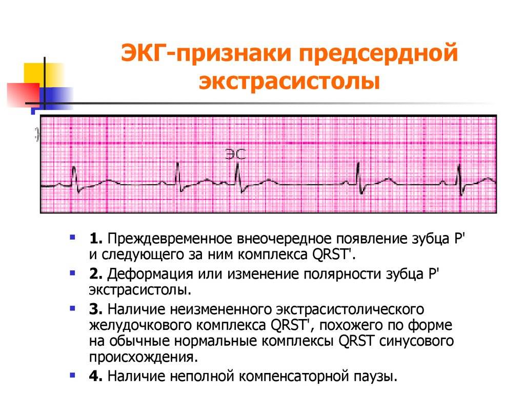 Синусовая аритмия сердца