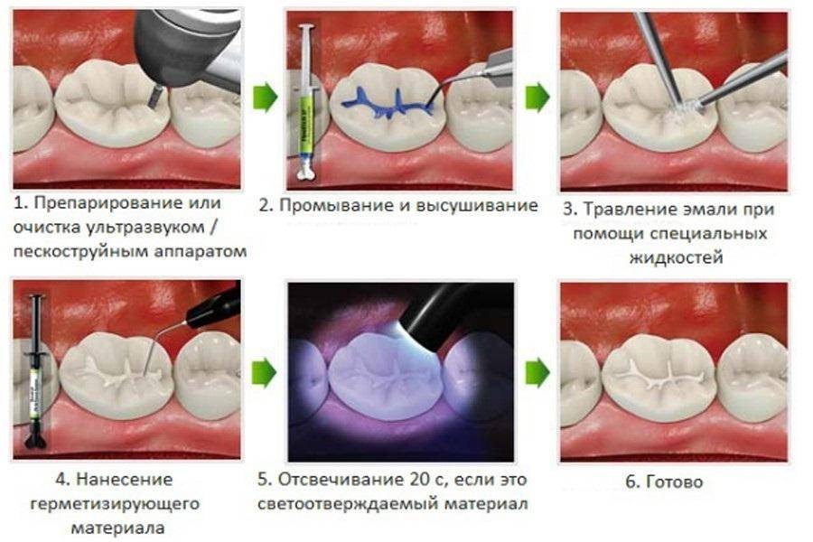 Гипоплазия зубов |