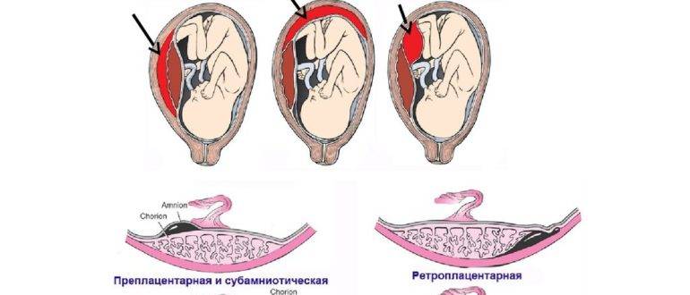 Преждевременная отслойка нормально  расположенной плаценты