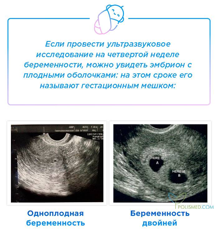 Пренатальный скрининг: мифы и заблуждения. первый и второй скрининг при беременности. ультразвуковой скрининг.