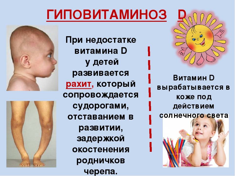 Рахит у ребенка. лечение и профилактика