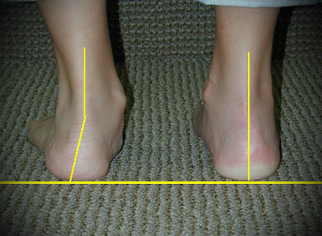 Ортопедическая операция ног. Плоскостопный вальгусная стопа. Плоскостопии и вальгусной косточке. Плано-вальгусная деформация.