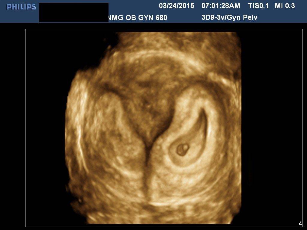 Узи после криопереноса. УЗИ при имплантации эмбриона в матку. Матка после подсадки эмбрионов. Эмбрион в матке после переноса на УЗИ. Снимок УЗИ эмбриона при подсадке эко.
