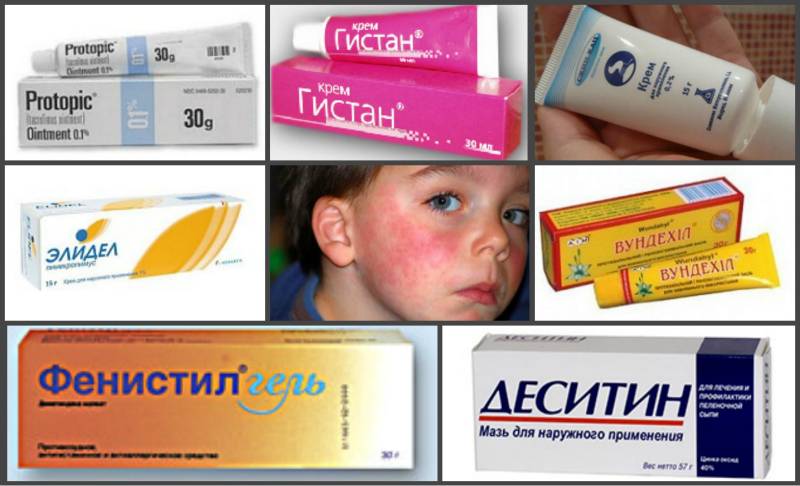 Мазь и крем от аллергии для детей - обзор популярных средств
