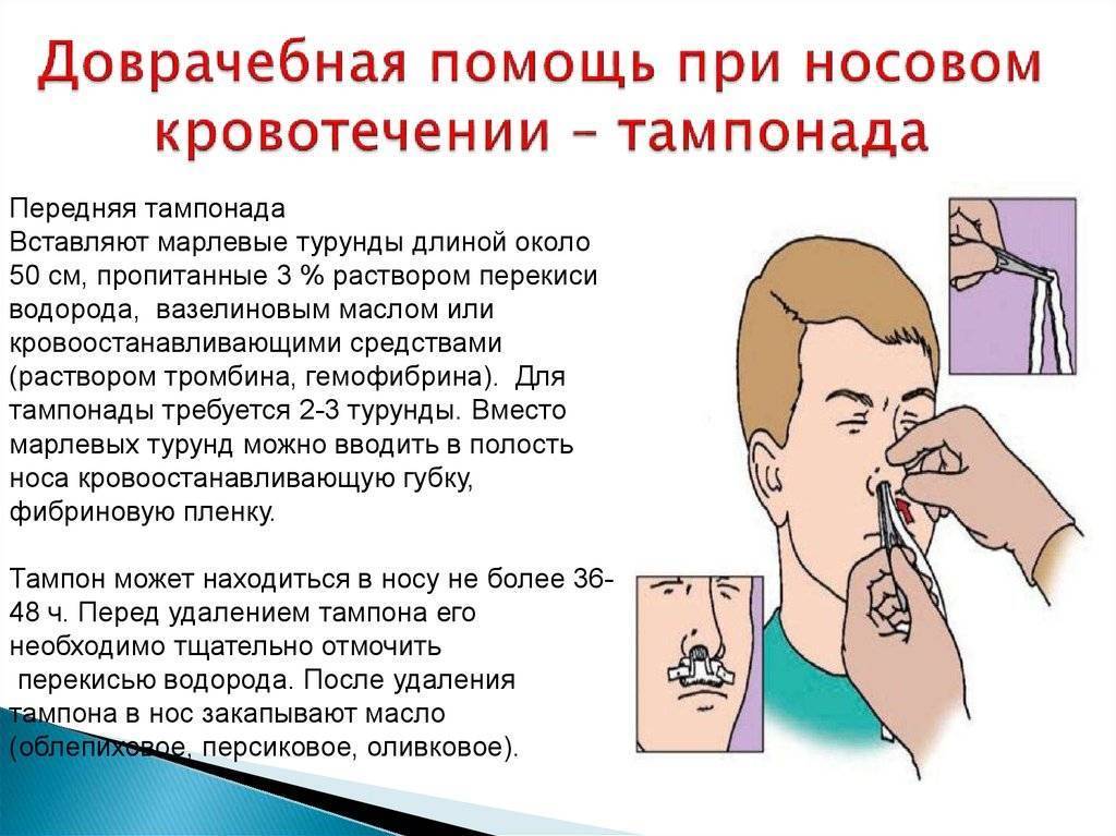 Кровотечение из носа: причины, как быстро остановить * клиника диана в санкт-петербурге