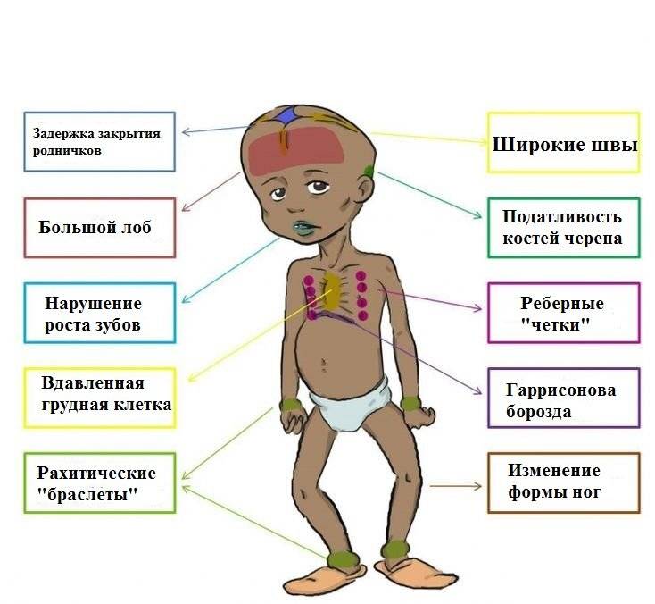 Е. комаровский: рахит - лечение, симптомы и признаки у детей