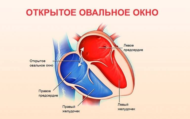 Врожденные пороки сердца у детей - причины заболевания и первые симптомы, профилактика и лечение болезни