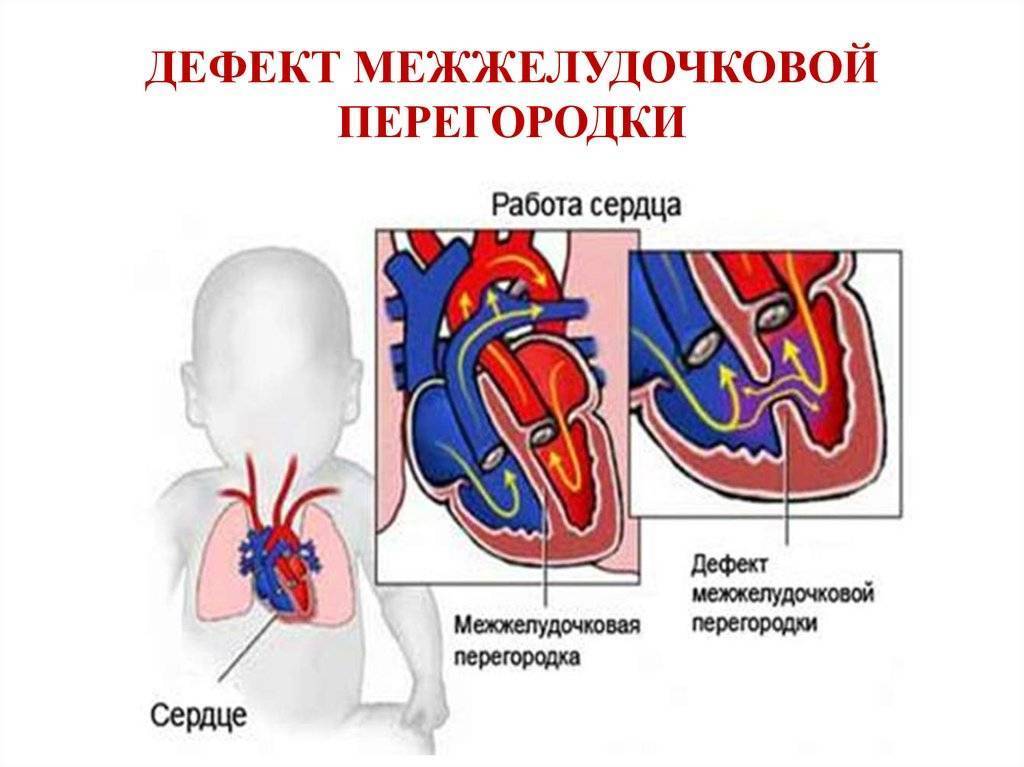 «шумное» сердце. о чём говорит этот симптом у новорождённого? | здоровье ребенка | здоровье