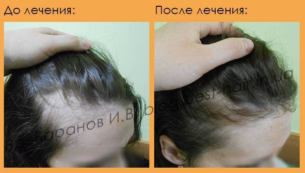 Ковид волосы выпадают что делать. Выпадение волос после родов. Сильно выпадают волосы после родов. Послеродовое выпадение волос. Сильное выпадение волос после родов.