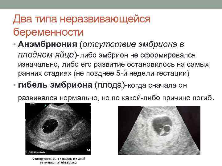 Замершая беременность | eurolab | гинекология