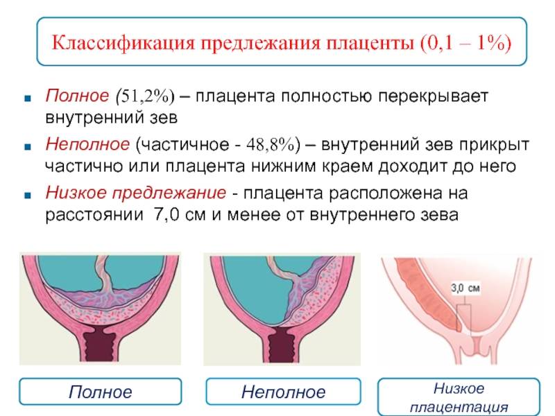 Предлежание сосудов – трагедия, которую можно предотвратить.