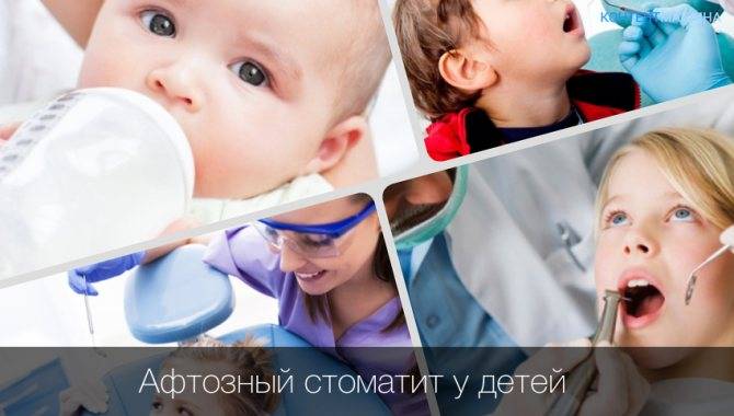 Стоматит у детей: причины возновения, виды, симптомы, тактики лечения
