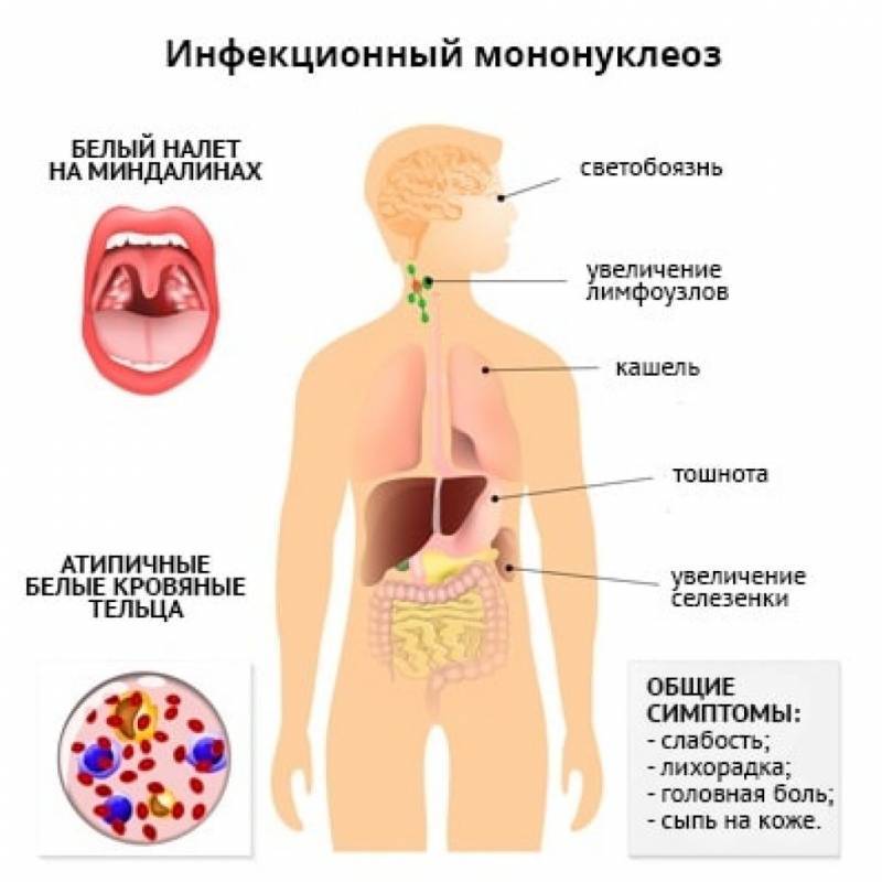 Ротавирусная инфекция (кишечный грипп): симптомы и лечение – напоправку