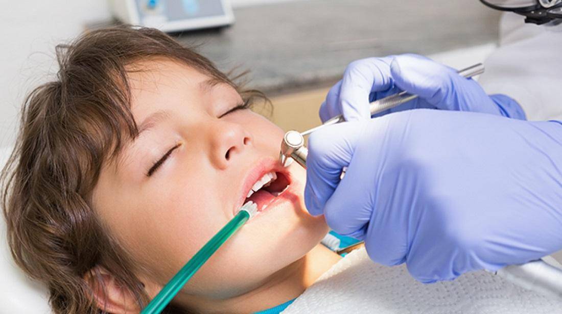 Лечение зубов под седацией у детей