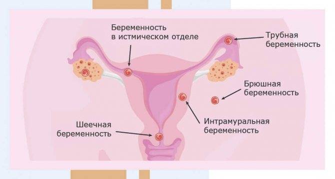 Беременность после переноса эмбрионов из «пробирки»