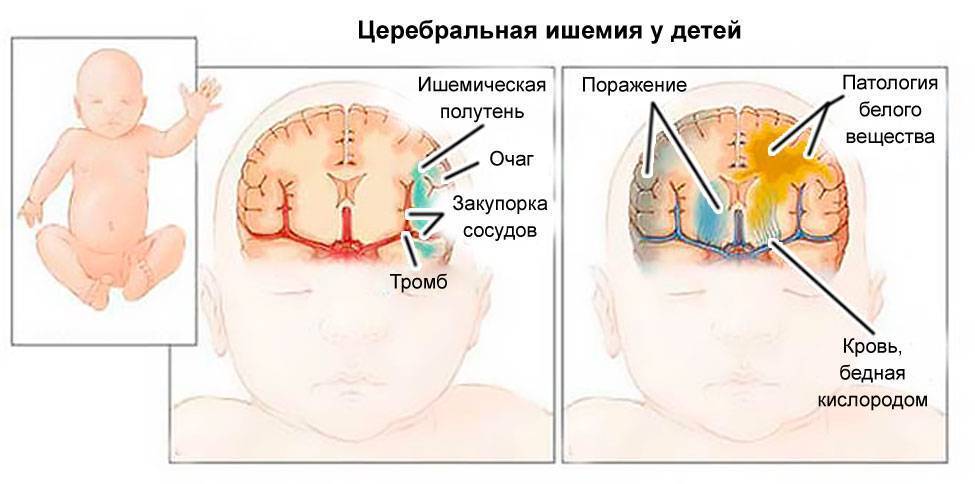 Хроническая ишемия головного мозга (хигм)