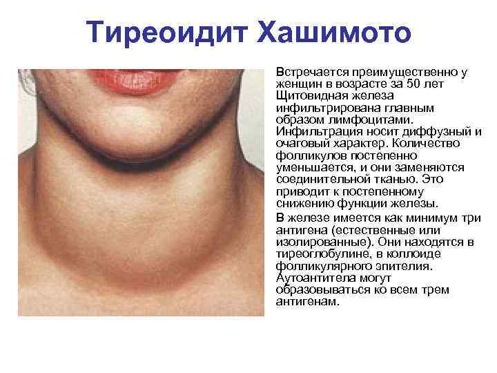 Психосоматика: щитовидная железа — причины и последствия заболеваний. (гипотиреоз, как следствие пассивности)  - psy-practice.com