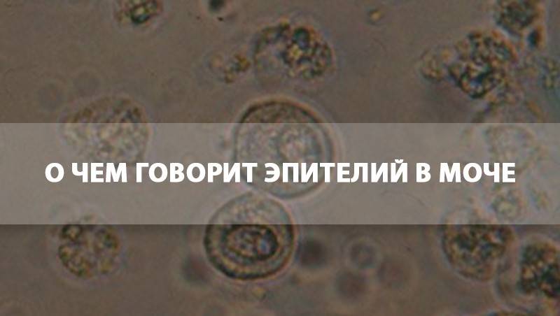 Плоский эпителий в моче повышен у женщин. Эпителий в моче у женщин. Эпителий в моче норма. Эпителий в моче причины. Хлопья эпителия в моче.