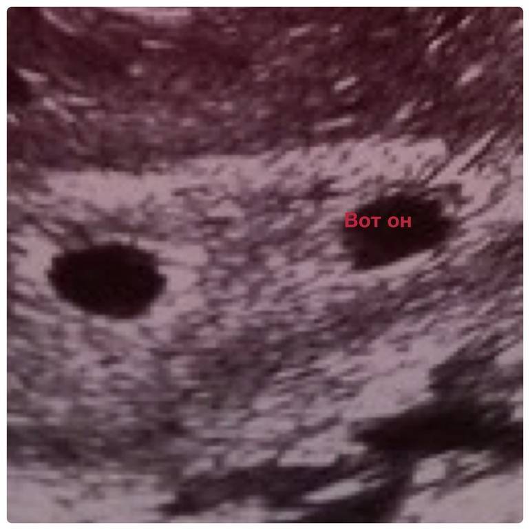 Отслойка эндометрии. Плодное яйцо на 6 неделе беременности. УЗИ плодное яйцо 6 недель. Плодное яйцо при беременности 5 6 недель.