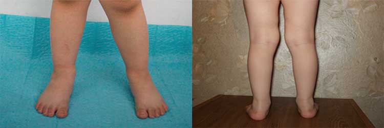 Лечение при плоско-вальгусной стопе у ребенка