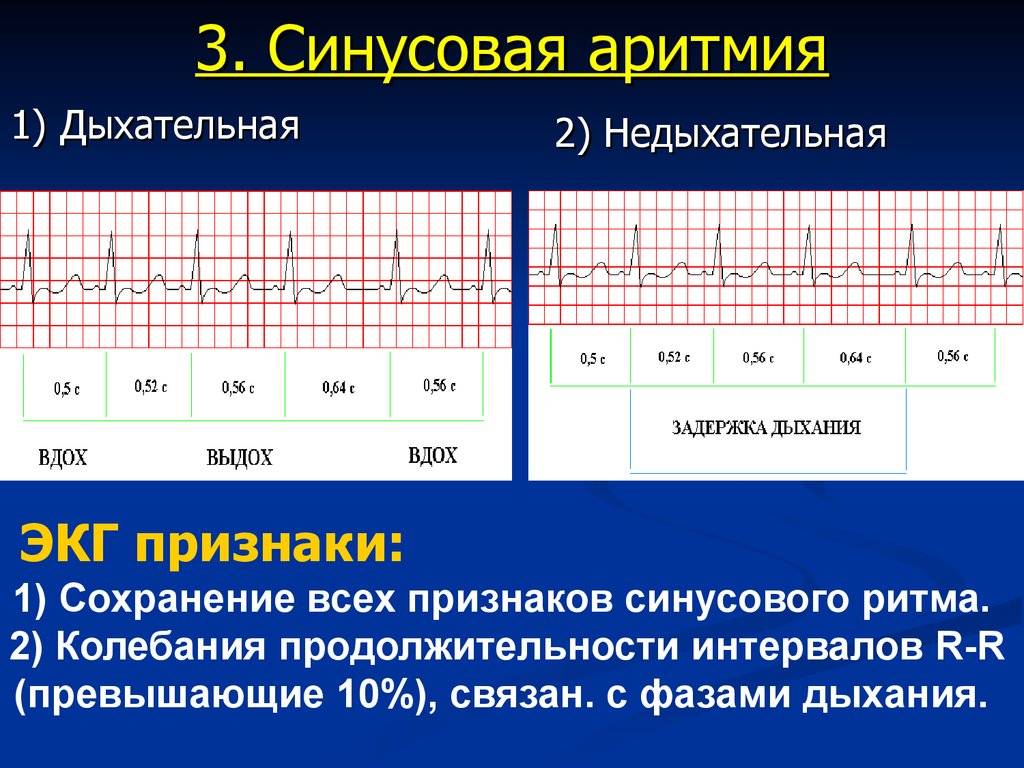 Расшифровка экг: наиболее важные показатели кардиограммы с примерами нарушений | университетская клиника