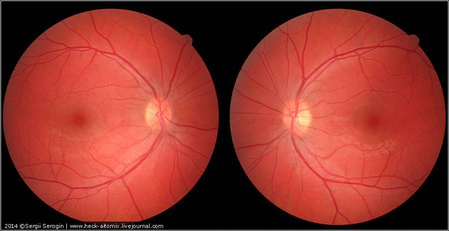 Ангиопатия сетчатки глаза: диагностика и лечение | клиника санта