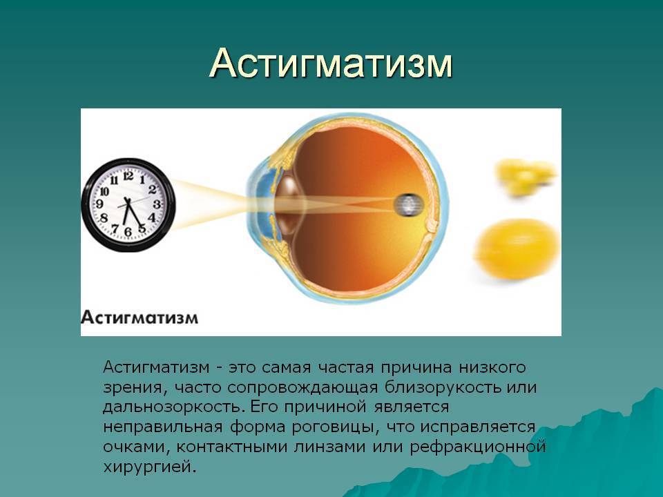 Доктор Комаровский об астигматизме у детей