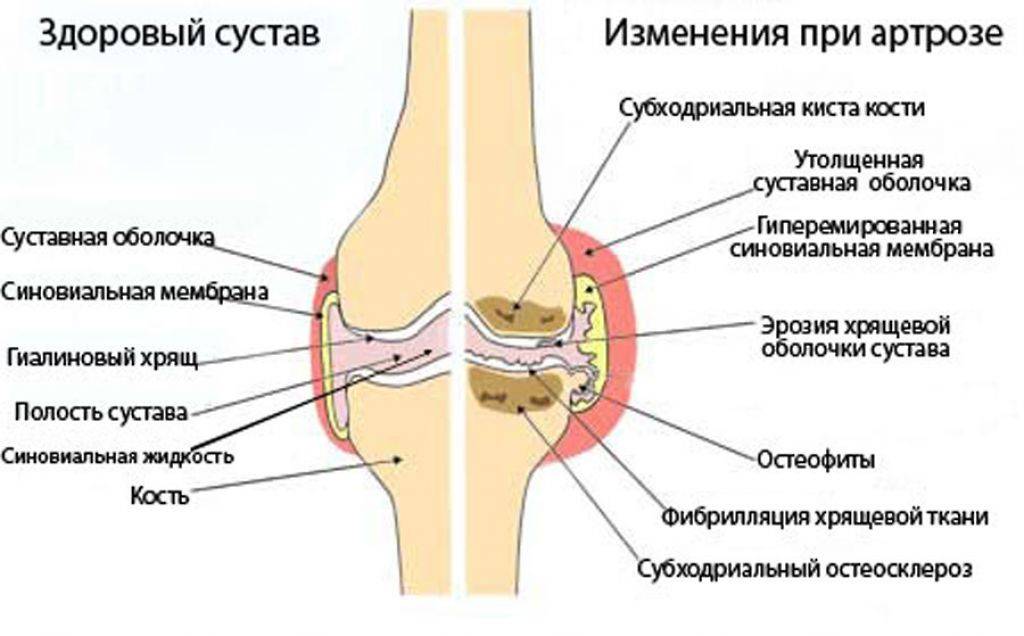 Врач объяснил, почему у вас могут хрустеть суставы