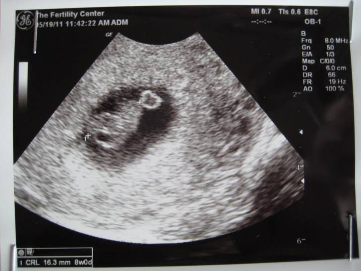 7 неделя беременности :: polismed.com