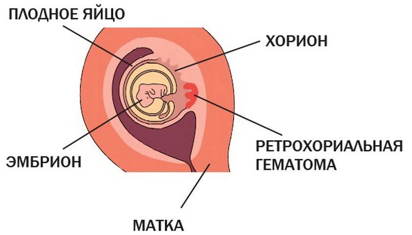 Ретрохориальная гематома при беременности, выделения, гематома в матке, размер, лечение и причины