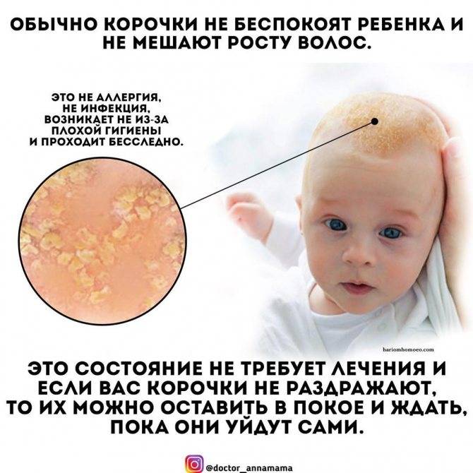 Доктор комаровский - как убрать корочки на голове у младенца и нужно ли их вычесывать?