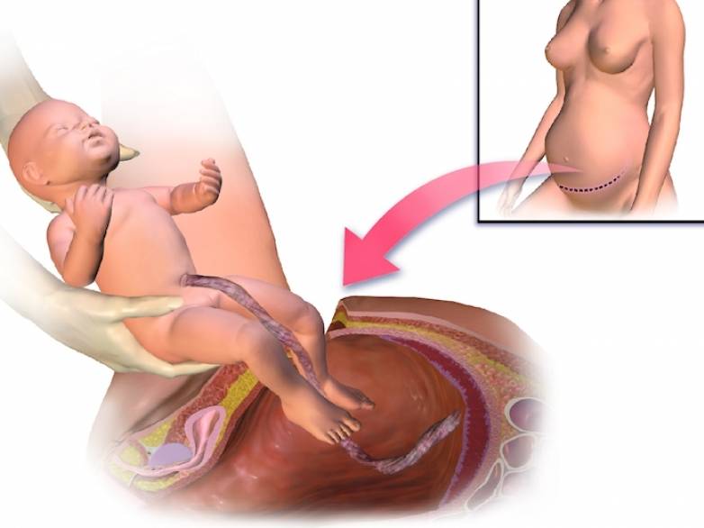 Беременность после кесарева: когда можно, через сколько, как проходит, симптомы второй, третьей, сколько можно рожать