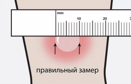 Что такое папула при манту и какой должен быть размер по годам
