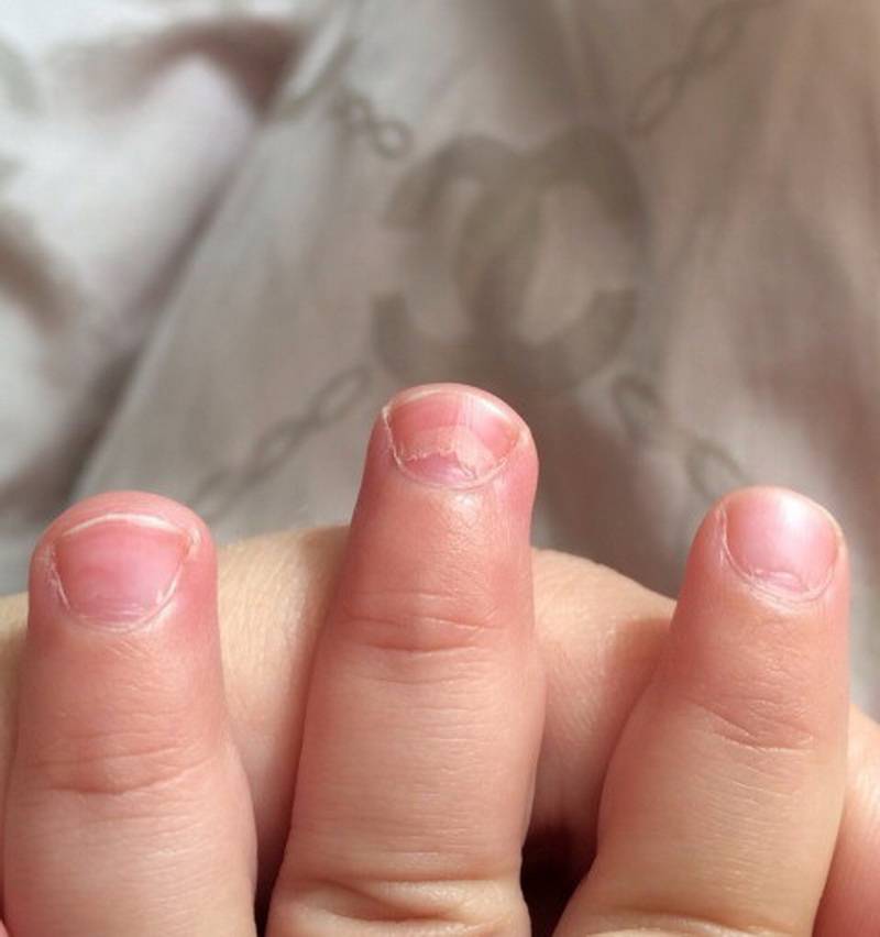 У ребенка слоятся ногти на ногах и на руках: советы комаровского
