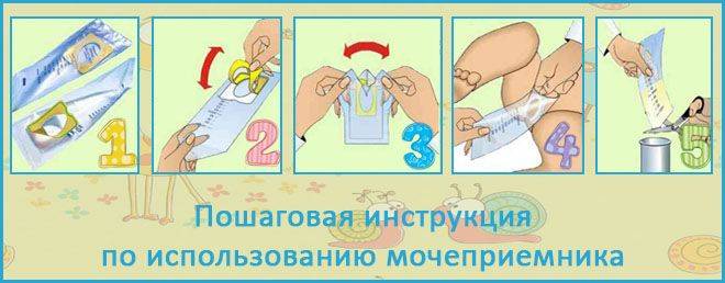Сбор мочи у новорожденных ~ факультетские клиники иркутского государственного медицинского университета