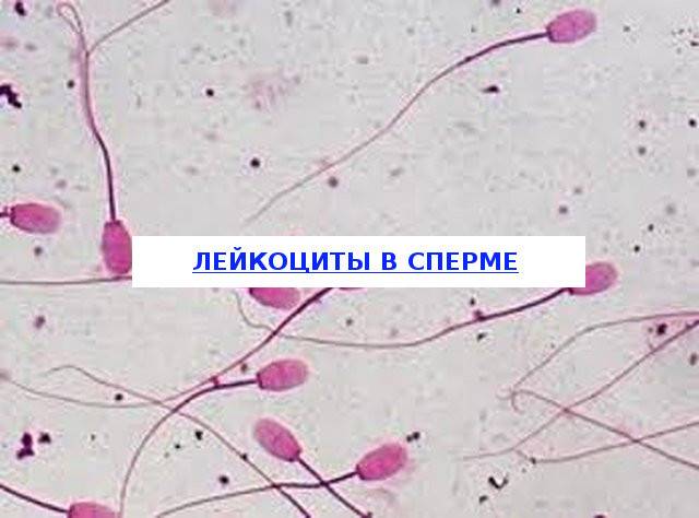 Лейкоцитурия – лейкоциты в моче