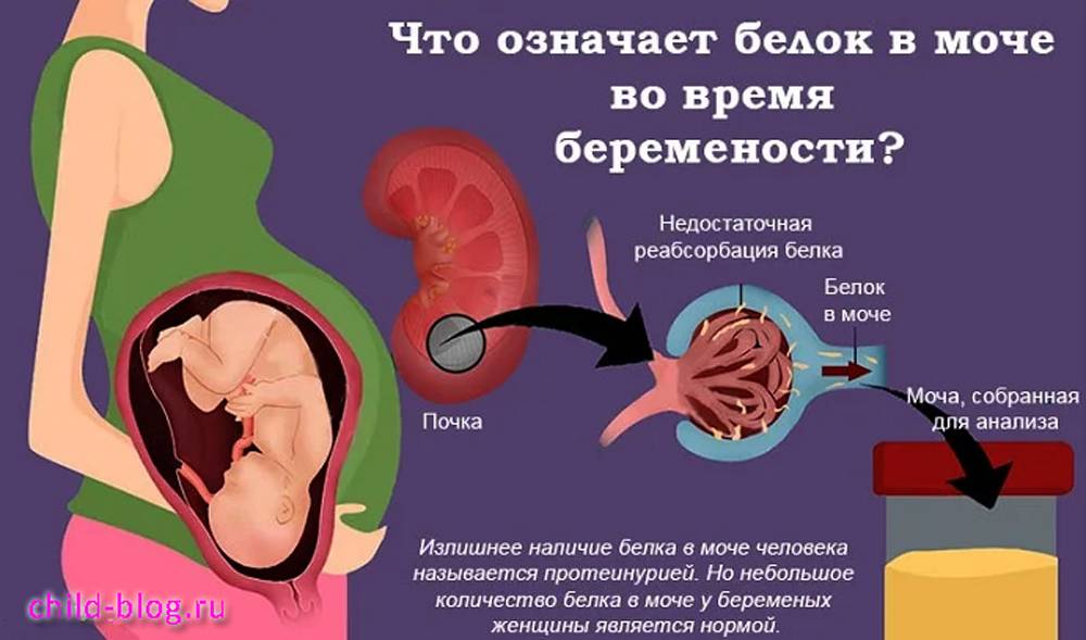 Белок в моче (протеинурия): причины, факторы риска, влияние на беременность