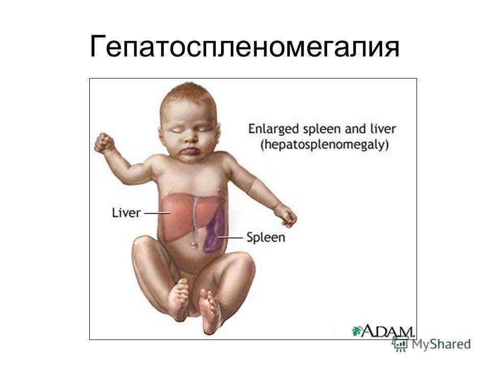 Увеличена печень у новорожденного. Синдром гепатоспленомегалии. Гепатоспленомегалии что такое у детей. Синдром гепатомегалии и гепатоспленомегалии.