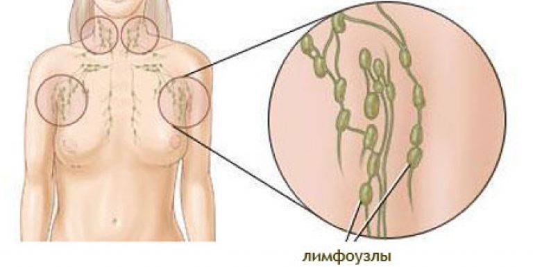 Подмышечные лимфоузлы. Воспаление аксиллярных лимфоузлов. Лимфатические узлы молочная железа воспаление. Лимфаденит молочные железы. Лимфаденит подмышечных узлов.