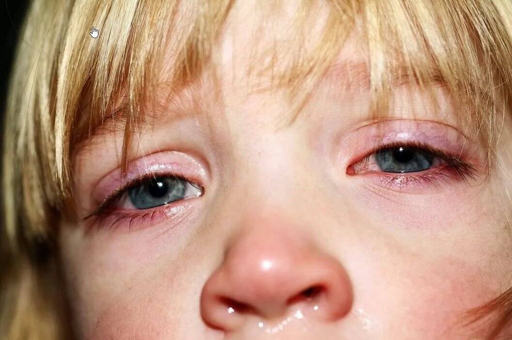 Конъюнктивит и заложенность носа у ребенка