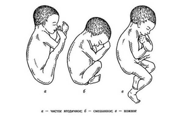 Упражнения для беременных, чтобы ребенок перевернулся головкой вниз: какая гимнастика желательна при тазовом предлежании плода и есть ли ограничения для зарядки?