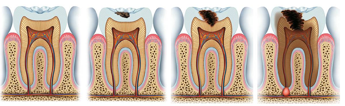 Пульпит – лечить или удалять зуб