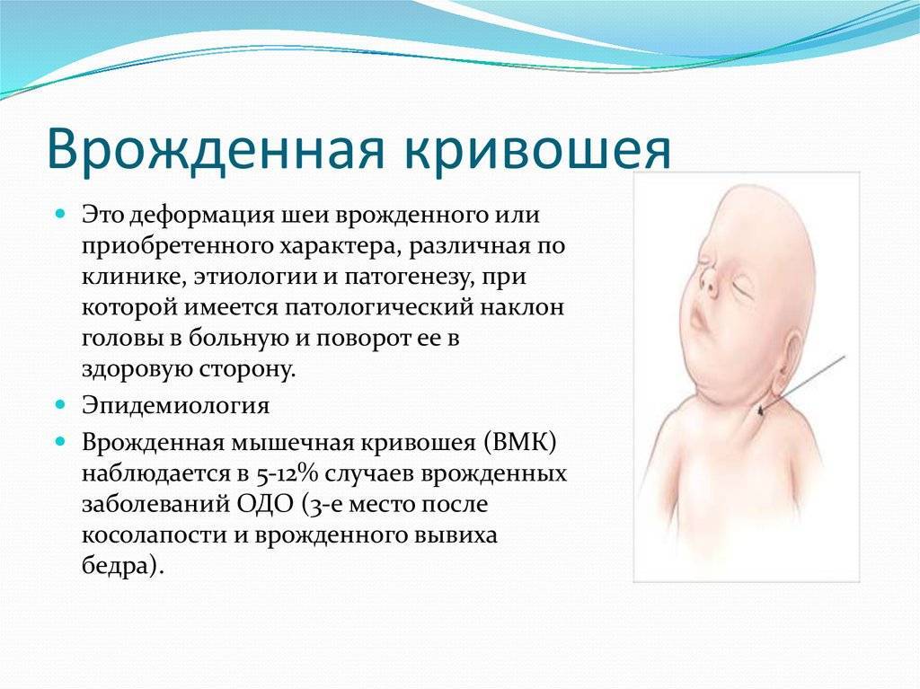 Кривошея у детей | лечение кривошеи у новорожденных | fortis