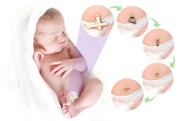 Инструкция по уходу и обработке пупка у младенца