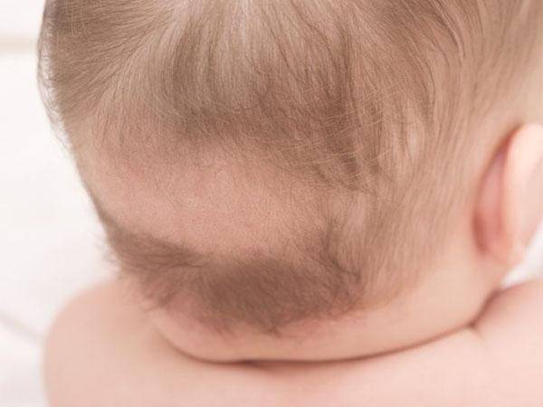 Лысина на голове у мужчин: лечение, причины, как избавиться от облысения макушки?